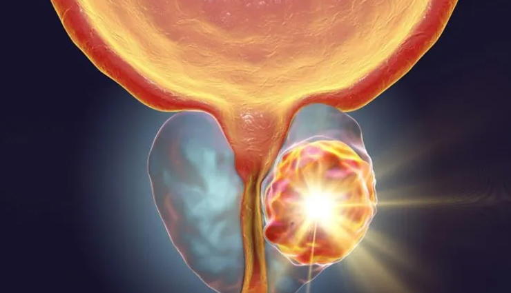 world cancer day common cancer types,10 most common cancers awareness,types of cancer to be aware of,common cancers on world cancer day,cancer prevalence and awareness,top 10 cancer types you should know,understanding common cancer varieties,global awareness of common cancers,key cancer types for awareness,world cancer day information on cancers,common cancer statistics and awareness,important cancers to be aware of,know the prevalence of common cancers,significance of knowing common cancer types,cancer awareness through common types,recognizing the 10 most prevalent cancers