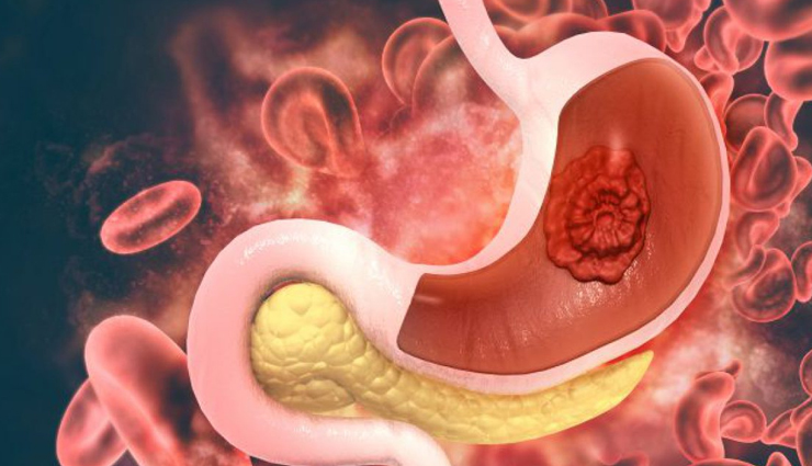 world cancer day common cancer types,10 most common cancers awareness,types of cancer to be aware of,common cancers on world cancer day,cancer prevalence and awareness,top 10 cancer types you should know,understanding common cancer varieties,global awareness of common cancers,key cancer types for awareness,world cancer day information on cancers,common cancer statistics and awareness,important cancers to be aware of,know the prevalence of common cancers,significance of knowing common cancer types,cancer awareness through common types,recognizing the 10 most prevalent cancers