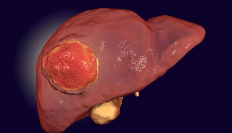 world cancer day common cancer types,10 most common cancers awareness,types of cancer to be aware of,common cancers on world cancer day,cancer prevalence and awareness,top 10 cancer types you should know,understanding common cancer varieties,global awareness of common cancers,key cancer types for awareness,world cancer day information on cancers,common cancer statistics and awareness,important cancers to be aware of,know the prevalence of common cancers,significance of knowing common cancer types,cancer awareness through common types,recognizing the 10 most prevalent cancers