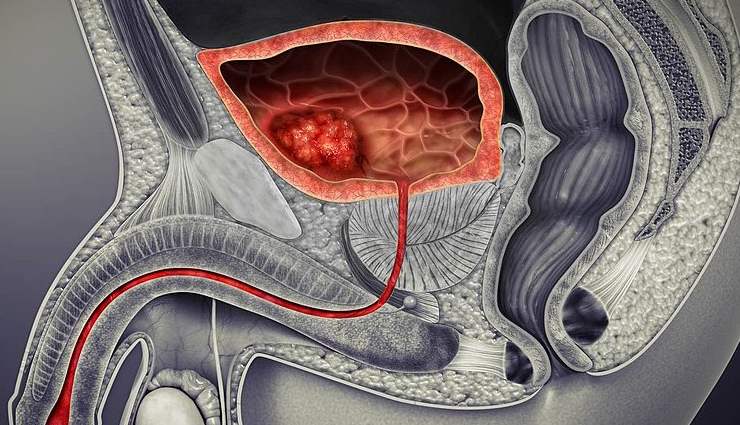 world cancer day common cancer types,10 most common cancers awareness,types of cancer to be aware of,common cancers on world cancer day,cancer prevalence and awareness,top 10 cancer types you should know,understanding common cancer varieties,global awareness of common cancers,key cancer types for awareness,world cancer day information on cancers,common cancer statistics and awareness,important cancers to be aware of,know the prevalence of common cancers,significance of knowing common cancer types,cancer awareness through common types,recognizing the 10 most prevalent cancers