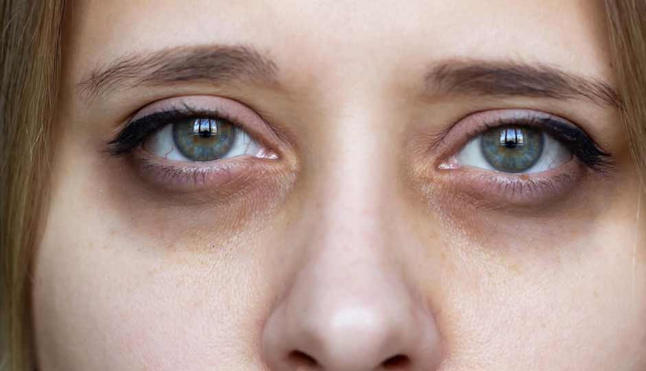 10 Home Remedies to Treat Under-Eye Dark Circles