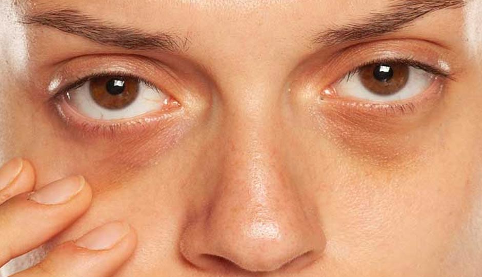 8 DIY Ways To Treat Under Eye Dark Circles