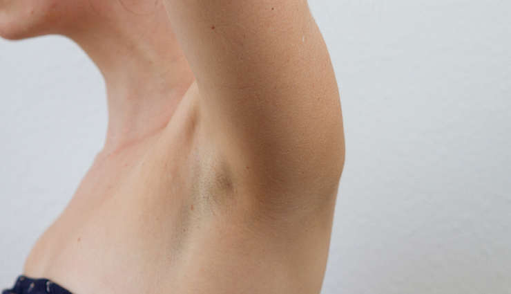 5 Major Causes of Underarm Allergies and Their Remedies