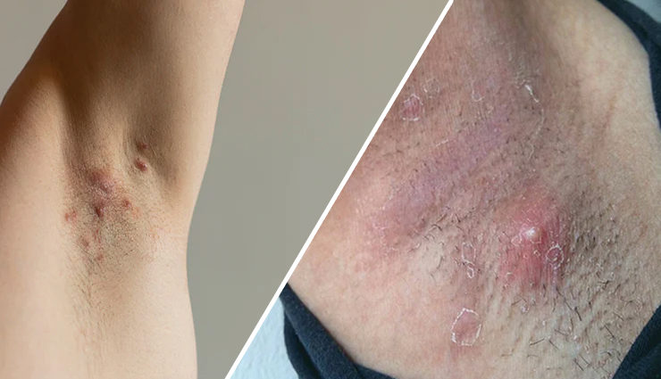 12 Home Remedies To Treat Underarm Pimples