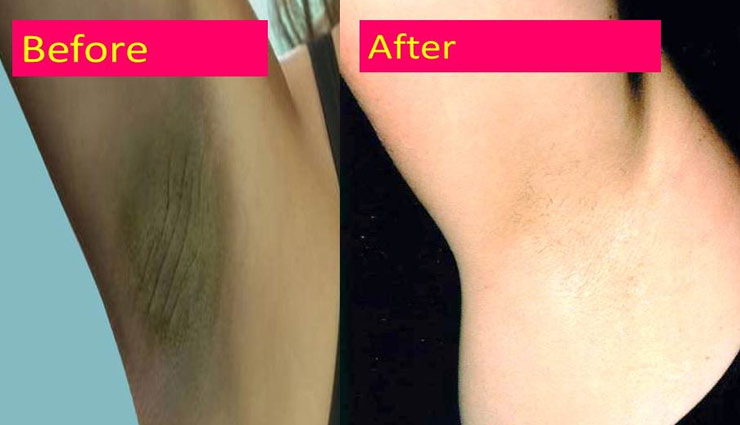 अंडरआर्म्स का कालापन करता है आपको शर्मिंदा, इन घरेलू नुस्खों से दूर करें यह समस्या