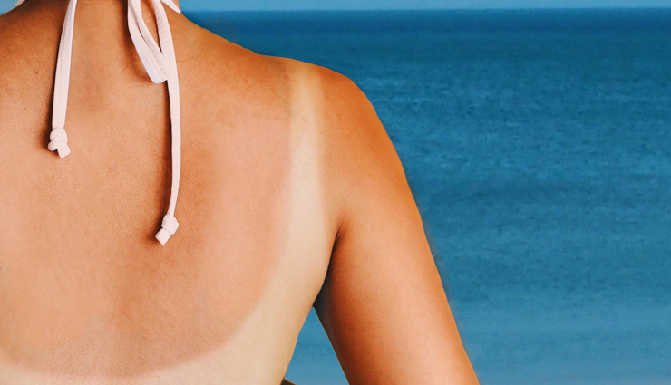 7 Simple Hacks To Treat Sunburn The Natural Way