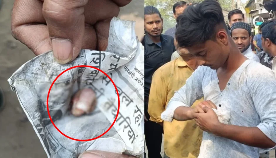 सिगरेट के 7 रुपये को लेकर बवाल, युवक ने दुकानदार की उंगली दांतों से काटकर कर दी अलग