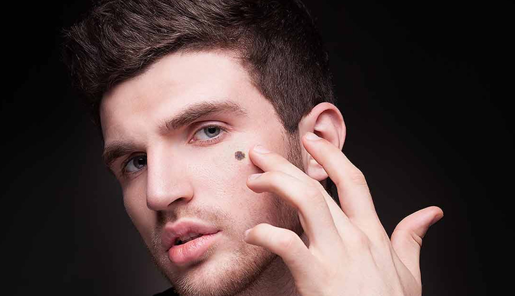 Home Remedies to Get Rid of Facial Mole