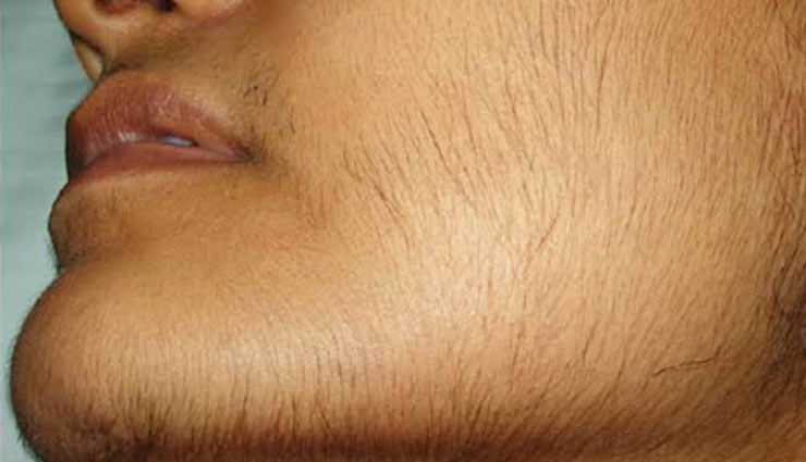 5 Natural Ways To Get Rid of Unwanted Hair