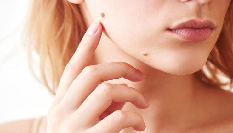 चहरे के अनचाहे तिल छीनते हैं सुंदरता, ये घरेलू नुस्खें बेहद काम के 