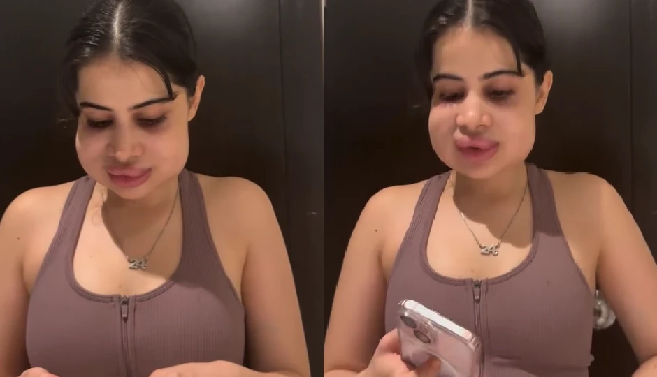 सूजा चेहरा, लेकिन कॉन्फिडेंस बरकरार! उर्फी जावेद ने फिर जीता फैंस का दिल, लिप फिलर रिमूवल के बाद शेयर किया वीडियो