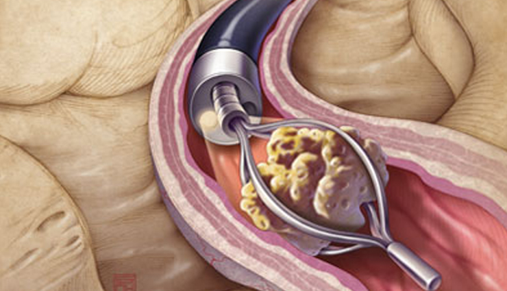क्यूँ और कैसे होती है गुर्दे (किडनी) की पथरी, जानिये कारण और उपचार causes of kidney stones,kidney stone formation reasons,remedies for kidney stones,how to prevent kidney stones,kidney stone prevention tips