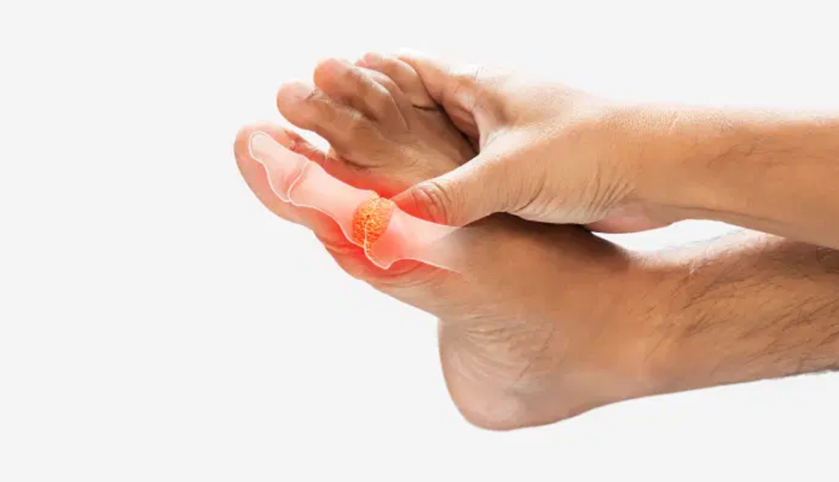 12 Home Remedies To Help You Reduce Uric Acid