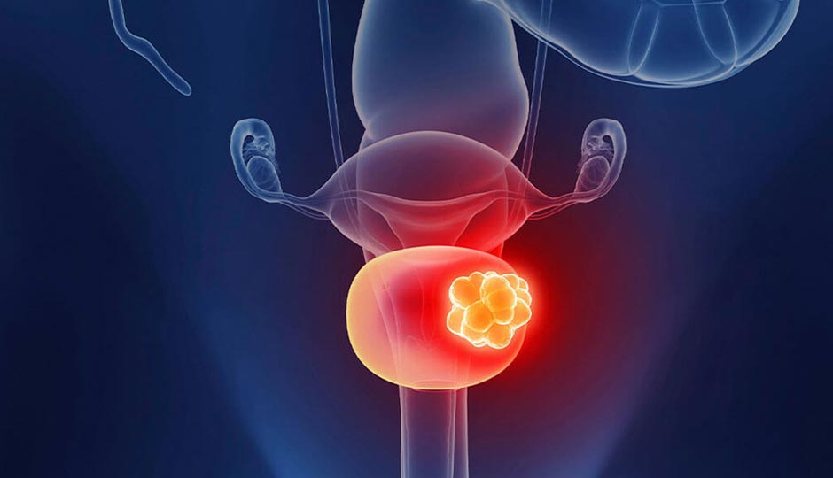 7 Ways To Treat Urinary Bladder Cancer