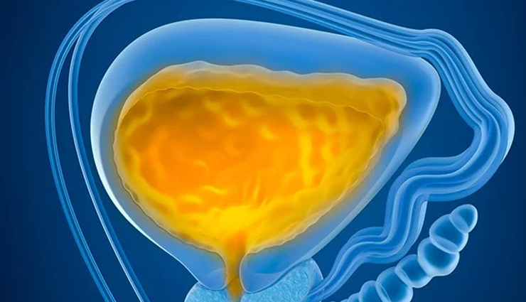 bladder cancer,symptoms of bladder cancer,bladder cancer causes,what is bladder cancer,early signs of bladder cancer,bladder cancer diagnosis,bladder cancer treatment,risk factors for bladder cancer,bladder cancer prevention,bladder cancer stages,bladder cancer prognosis,bladder cancer awareness,bladder cancer in women,bladder cancer in men,bladder cancer survival rate