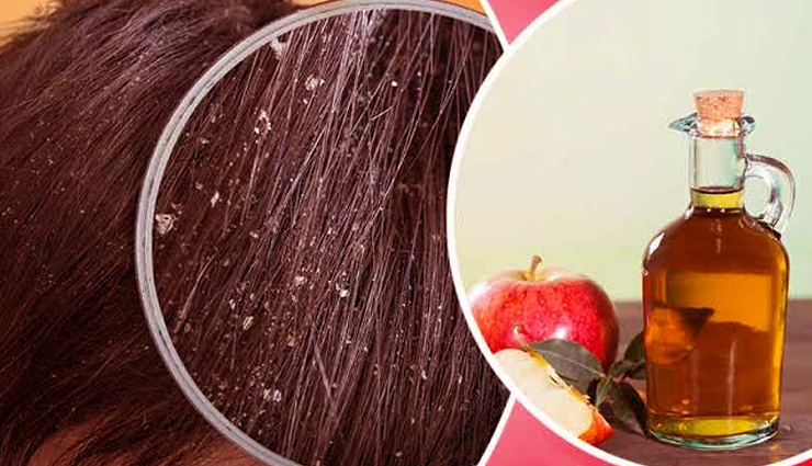 dandruff treatment,home remedies dandruff,scalp,dandruff treatment,dandruff funguss,beauty,beauty tips