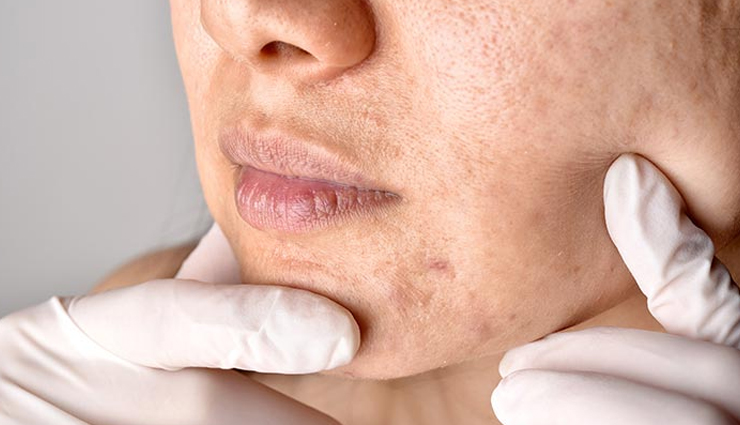 toner for reducing pore size,benefits of using toner,beauty tips,skin care tips