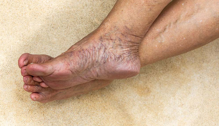 4 Home Remedies To Treat Varicose Veins