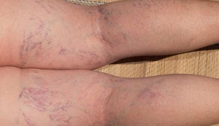 पैरों के दर्द को न करें नजरअंदाज, पैरों में दिखती हैं नीली नसें तो यह है वेरिकोज वेंस, इस उपचार से हो सकते हैं मुक्त