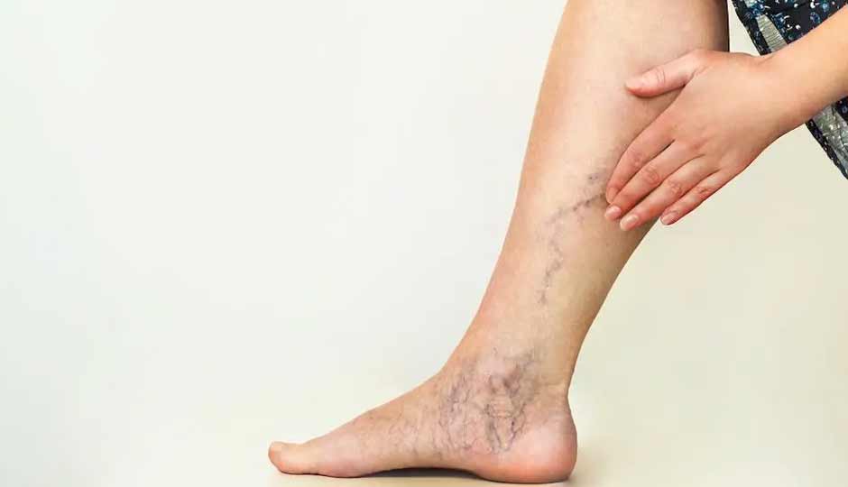 10 Home Remedies and Lifestyle Measures for Varicose Veins