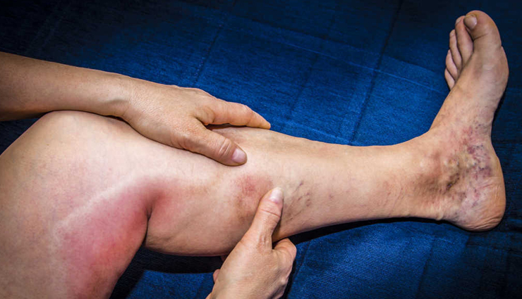 11 Remedies Best Suited for Deep Vein Thrombosis