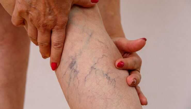 5 Makeup Tips To Help You Cover Varicose Veins