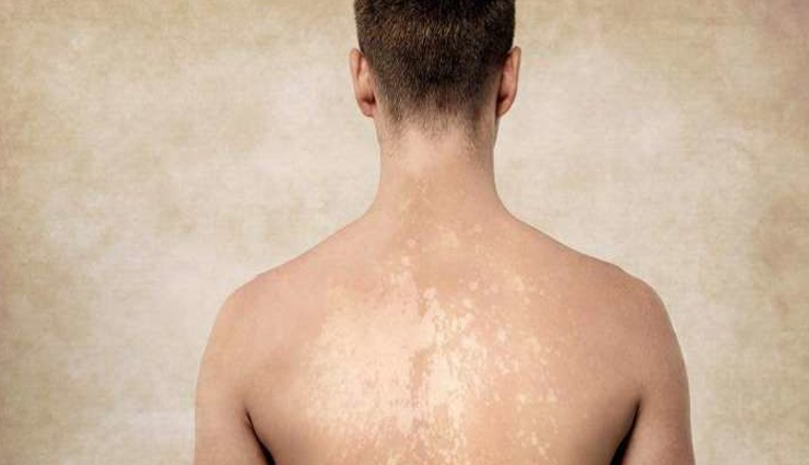 Home Remedies To Treat Tinea Versicolor
