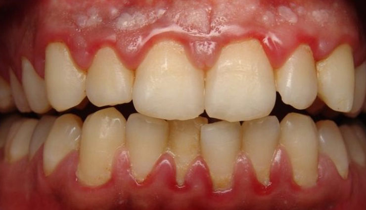 दांत हो चुके है पायरिया का शिकार, करें इन 4 प्राकृतिक तरीकों से उपचार Health tips,teeth care,victims of pyorrhea,home remedies