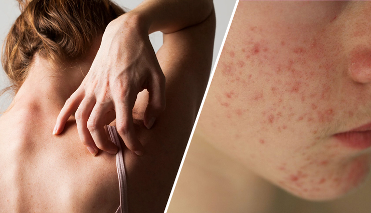 5 Skin Problems You Might Face Due To Vitamin D Deficiency