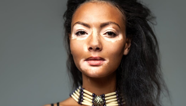 7 Home Remedies to Help You Manage Vitiligo
