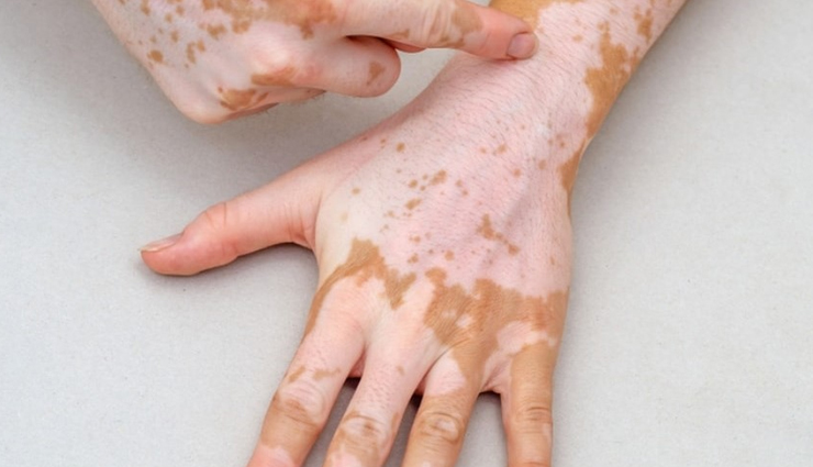 World Vitiligo Day 2023: What Is Vitiligo? Types, Symptoms, Causes 