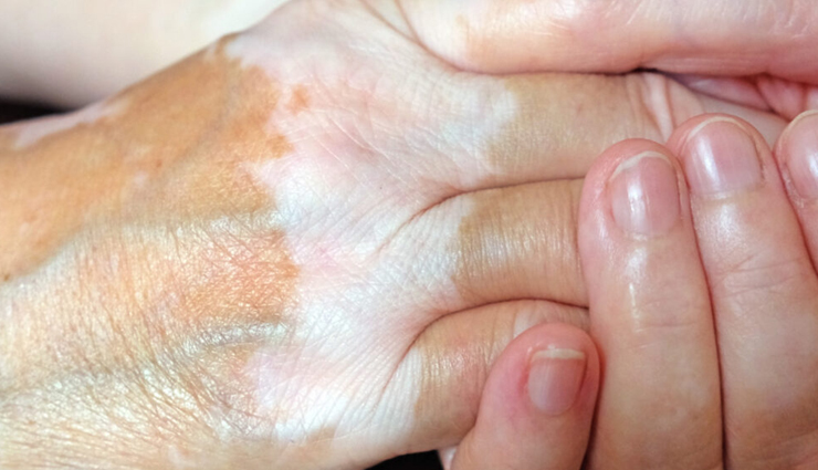 World Vitiligo Day 2023: 10 Home Remedies to Treat Vitiligo