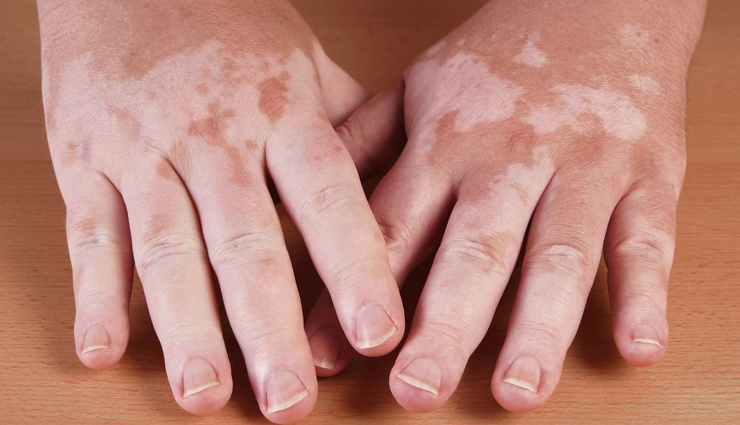 World Vitiligo Day 2023: 10 Foods to Avoid When You Have Vitiligo