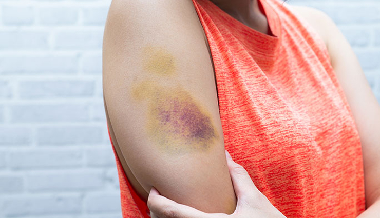 8 Remedies That are Effective for Von Willebrand’s Disease Symptoms