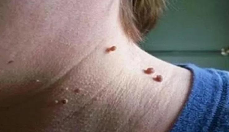 इन 2 फलों के छिलके से नहीं रहेगा मस्सों का नामोनिशान, जानें इस्तेमाल का तरीका