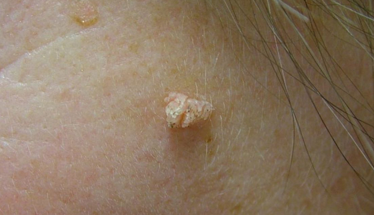 6 Home Remedies To Get Rid of Warts