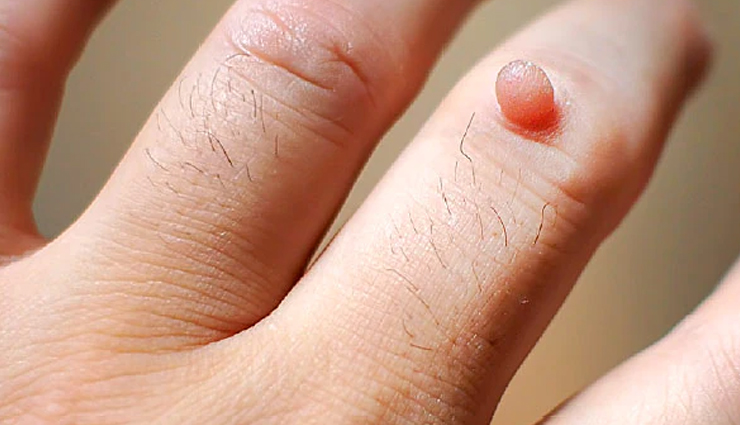 Remedies That May Be Helpful in the Treatment of Warts