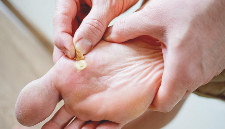 6 Ways To Treat Warts Naturally