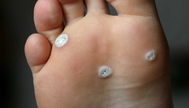 6 Remedies To Get Rid of Warts Naturally
