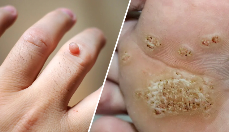 5 Home Remedies To Get Rid of Warts