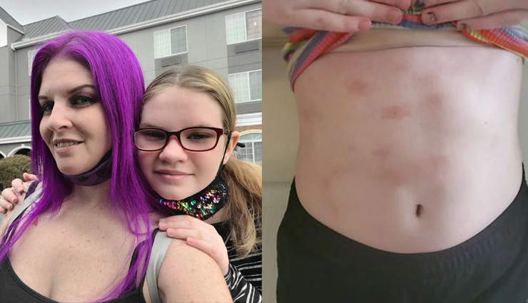 12 साल की इस लड़की को पानी से एलर्जी, नहाने से जा सकती है जान