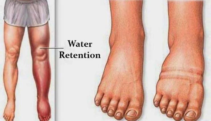 बेहद कष्टकारी हो सकती हैं वॉटर रिटेंशन की समस्या, लें इन घरेलू उपचारों की मदद