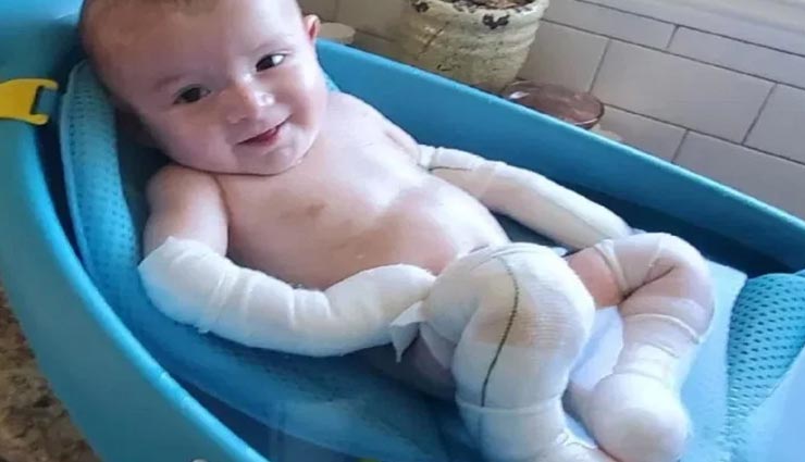 इस बच्चे को हुई विचित्र जानलेवा बिमारी, जानकर आपकी आंखों से भी छलक पड़ेंगे आंसू