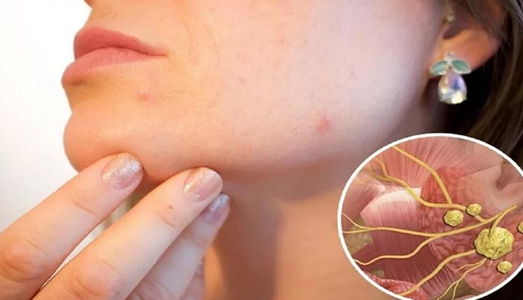 भोजन करते ही सूज जाते थे इराकी महिला के गाल, जांच में हुआ खुलासा, दिल्ली में हुआ इलाज 