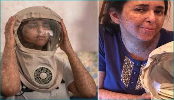 weird news,weird disease,space helmet,protect skin from sun