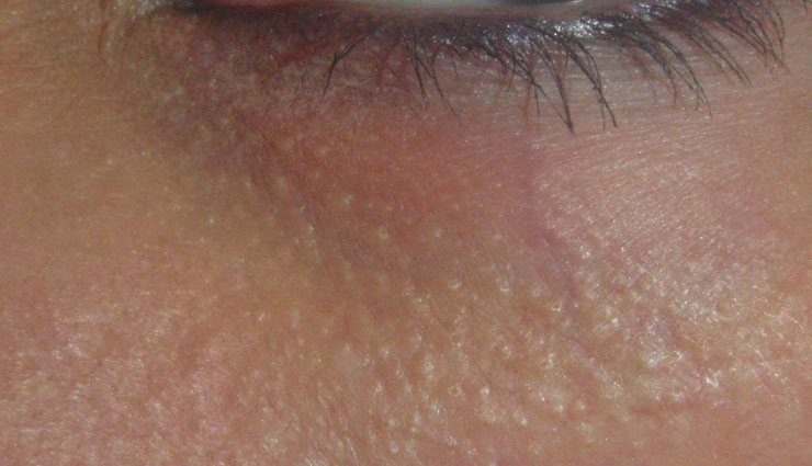 beauty tips,tips to remove bumps,simple beauty tips,quick beauty tips