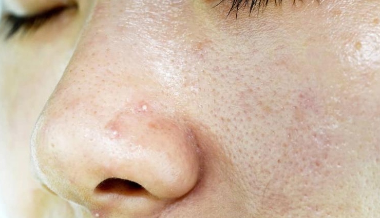 salicylic acid benefits for skin,skin benefits of salicylic acid,lesser-known benefits of salicylic acid for skin,salicylic acid advantages for skin care,salicylic acid and its positive effects on skin,benefits of using salicylic acid for healthy skin,salicylic acid for acne treatment and prevention,salicylic acid for exfoliating and unclogging pores,salicylic acid for reducing blackheads and whiteheads,salicylic acid and its role in skin cell turnover,salicylic acid for treating and preventing breakouts,salicylic acid for controlling excess oil and sebum,salicylic acid and its anti-inflammatory properties for skin,salicylic acid for reducing redness and inflammation,salicylic acid for improving skin texture and tone,salicylic acid for promoting a clearer and smoother complexion,salicylic acid and its benefits for acne-prone skin,salicylic acid for targeting stubborn blemishes and pimples,salicylic acid for enhancing the effectiveness of other skincare products,salicylic acid and its role in treating hyperpigmentation and uneven skin tone