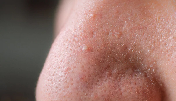 lemon and baking soda face mask,diy skincare remedies,homemade facial masks,natural exfoliation,skin detoxification,blackhead removal,whitehead removal,dark spot lightening,hyperpigmentation treatment,lemon juice benefits,baking soda skincare,facial mask recipes,brightening face masks,skin detox at home,skin rejuvenation methods