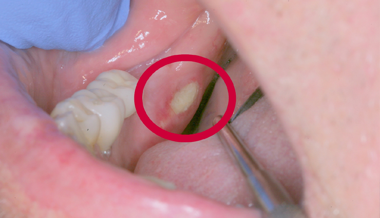 आम बात है मुँह का कैंसर होना, समय रहते किए गए इलाज से बचाया जा सकता है स्वयं को mouth cancer causes,oral cancer risk factors,tobacco and mouth cancer,alcohol and oral cancer,hpv and mouth cancer,sun exposure and lip cancer,unhealthy diet and mouth cancer,chewing tobacco and oral cancer,mouth cancer prevention,oral health and cancer development