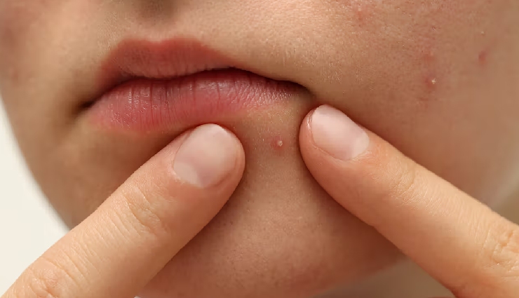 10 Ingredients You Can Apply on White Pimples To Pop Them Up